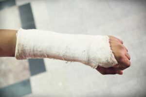 A broken wrist in plaster.